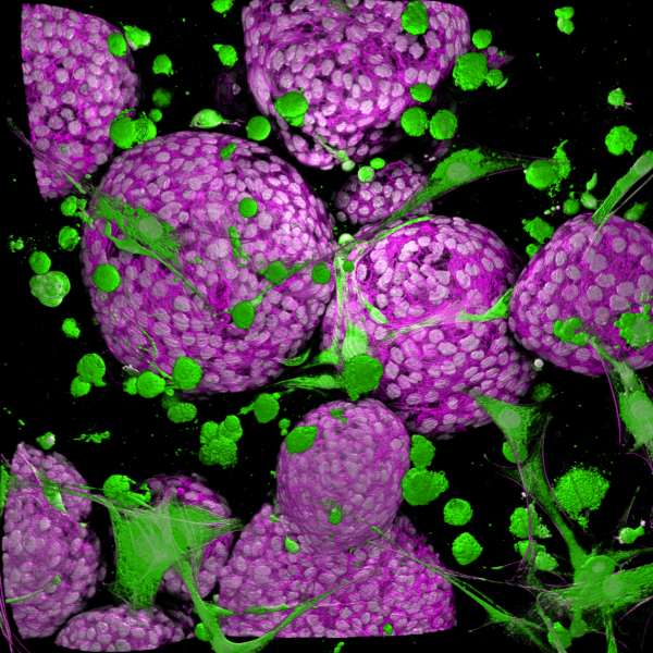 Tumor aggregates interact with surrounding mesenchymal cells. 2024, K Bera, Honorable Mention.