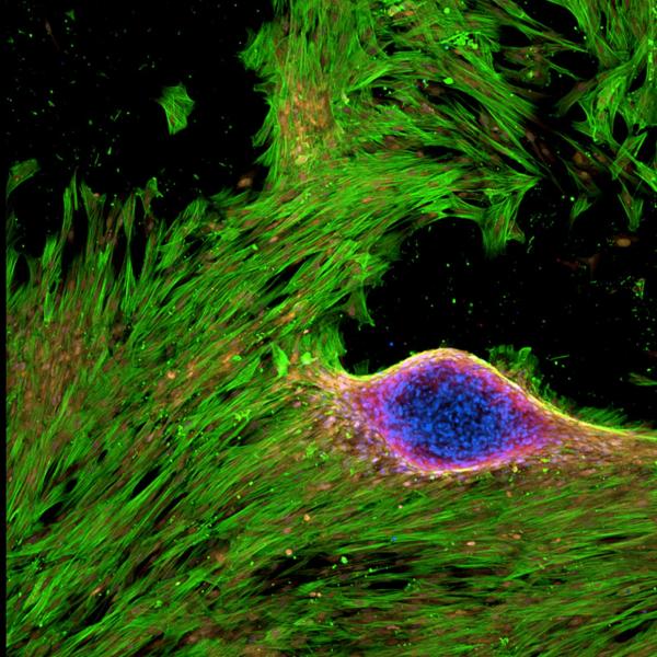 aSMA+ (green) VICs express RUNX2 (red) in osteogenic media. 2019, M Schroeder, Honorable Mention.