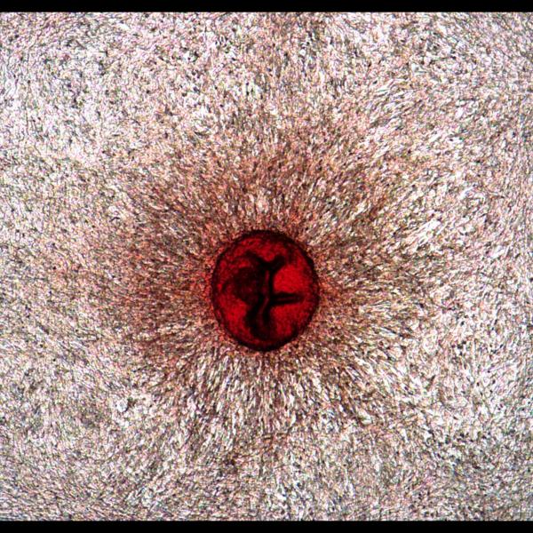 Sex-specific disease traits: stiff, calcified nodule in male heart valve. 2020, M Schroeder, Honorable Mention.