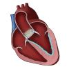 TAVR Heart