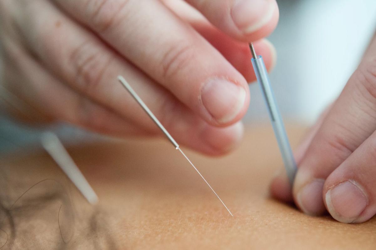 free acupuncture