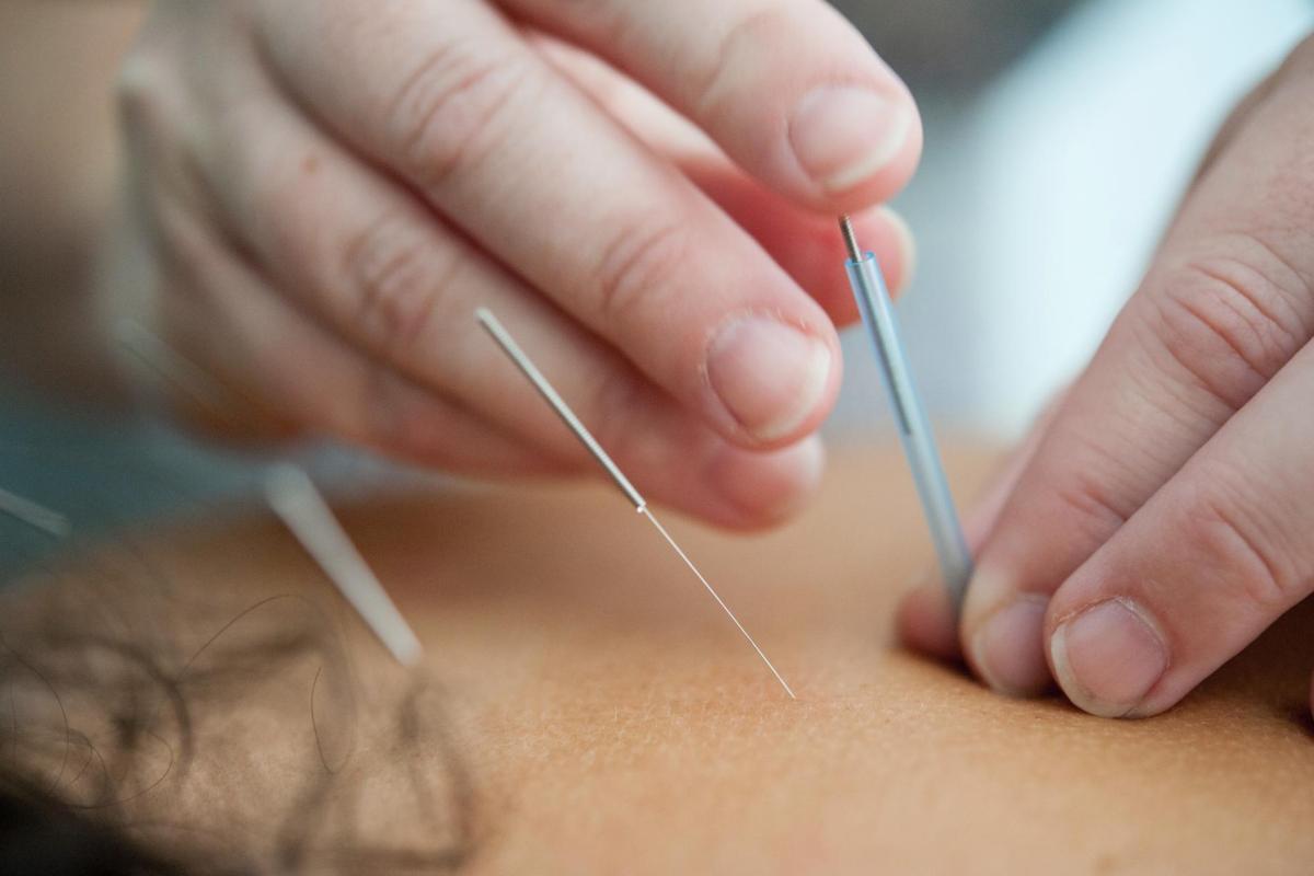 Acupuncture needles