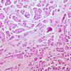 carcinoma