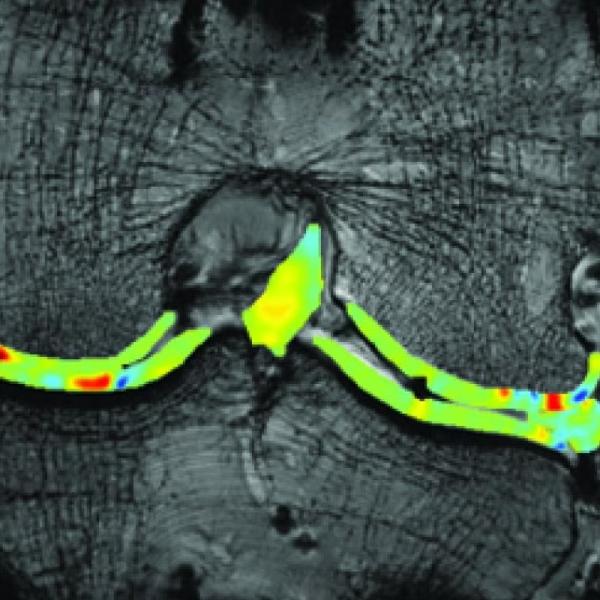 Pseudo colored MRI
