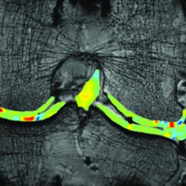 Pseudo colored MRI