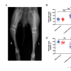 Effect of physeal injury on limb lengthening and angular deformity