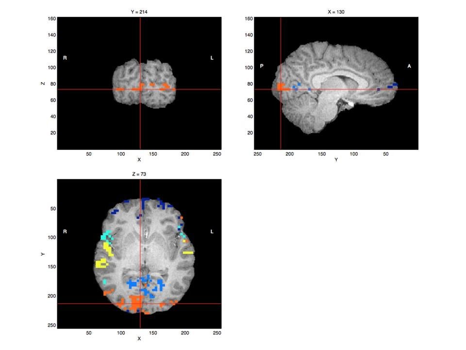 Functional MRI (fMRI) images that measures brain activity.