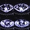 MRI scan of female pelvis