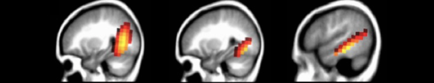 High Density EEG