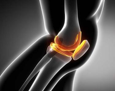 Osteoarthritis image