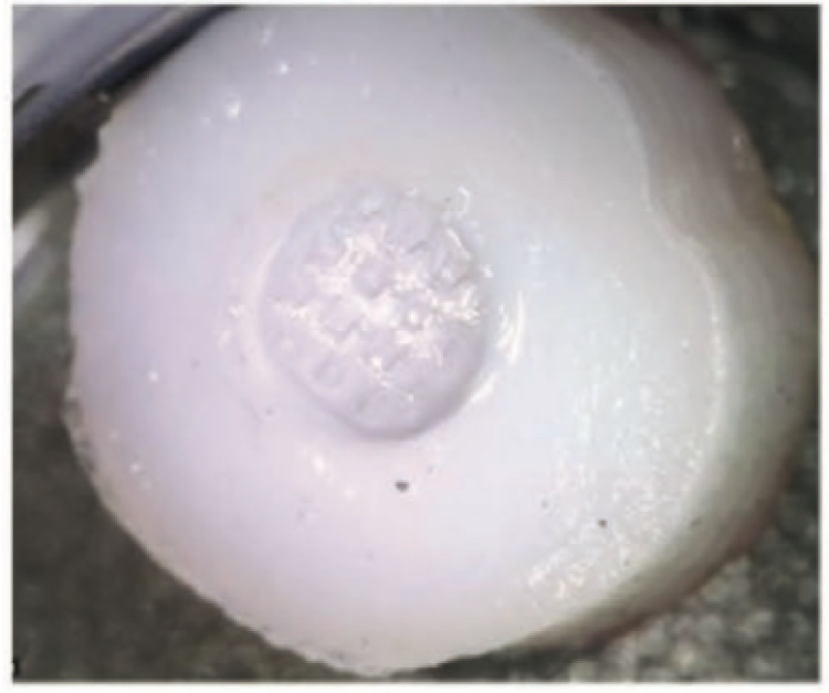 Printed implant in OC defect