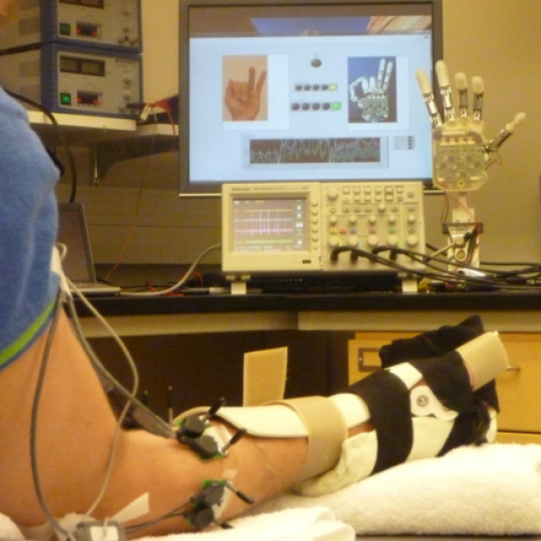A person's arm with a prosthetic hand