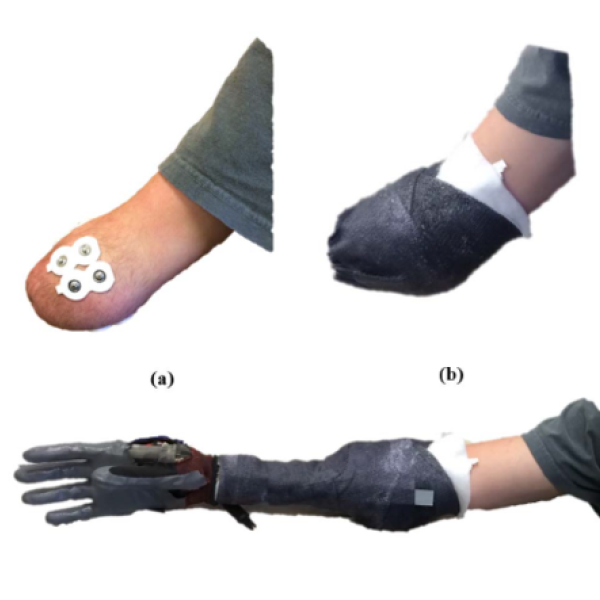 Three images, demonstrating how a prosthetic limb is attached to the arm.