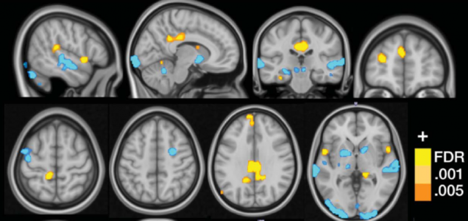 An MRI image showing the multivariate brain pattern that predicts fibromyalgia status on the basis of brain activation during multisensory stimulation.