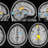 An MRI image showing the multivariate brain pattern that predicts fibromyalgia status on the basis of brain activation during multisensory stimulation.