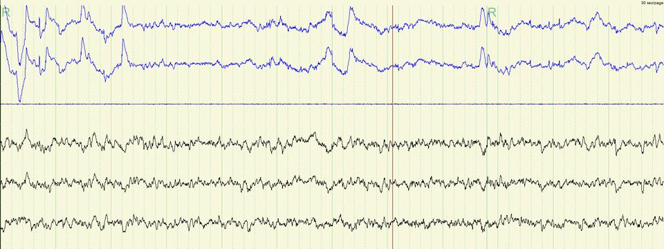 REM sleep EEG