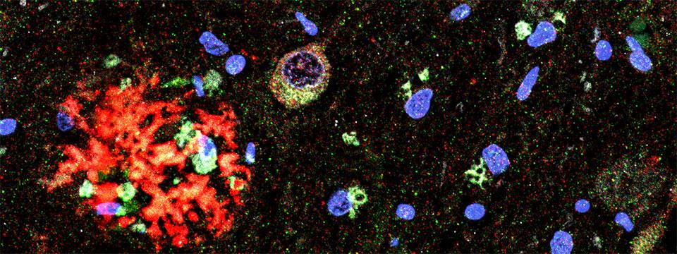 Alzheimer’s brain section stained for beta amyloid plaques (red), double stranded RNA (green), and DNA (blue)