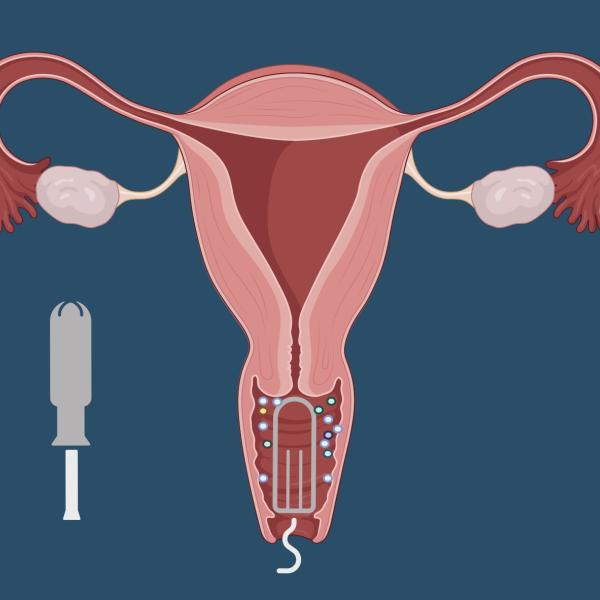 Vaginal Exposure thumbnail