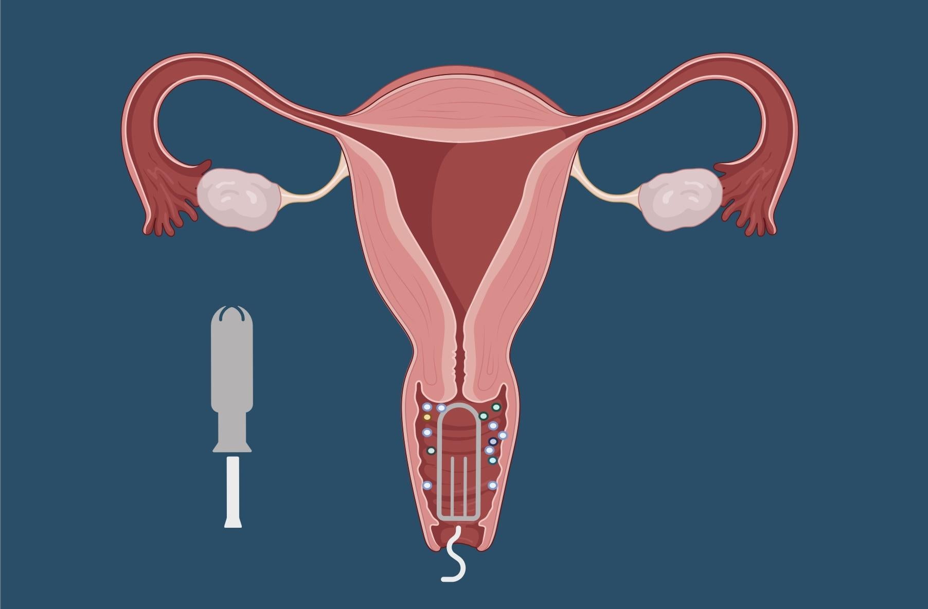 Vaginal Exposure thumbnail