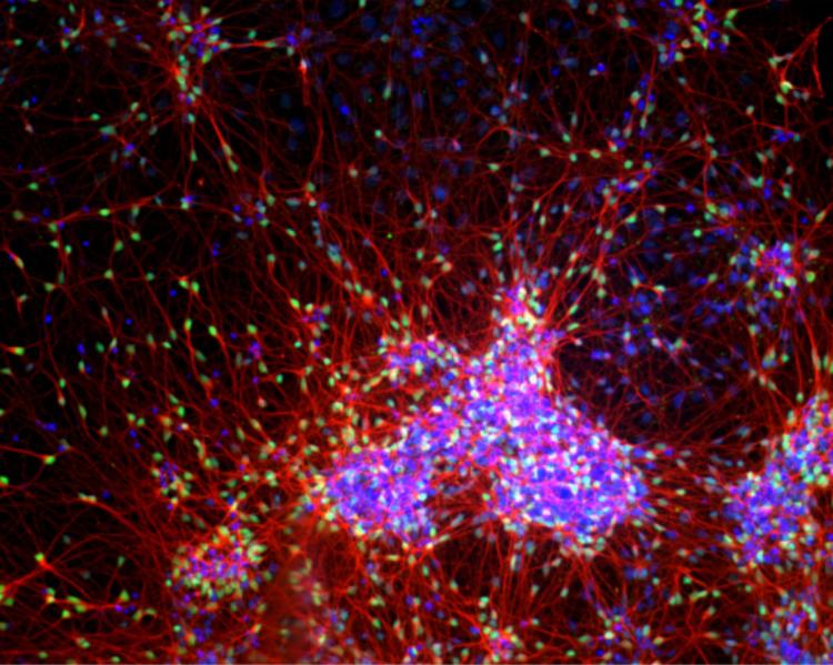 Cortical neuronal culture differentiated from iPSCs trisomic for chromosome 21 (40 days after initiation of differentiation protoco.)  The culture is stained for DNA (blue), beta tubulin III (red) and cortical layer VI transcription factor TBR1 (green).