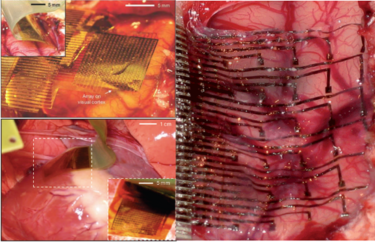 Close ups of the brain with biosensors on it.