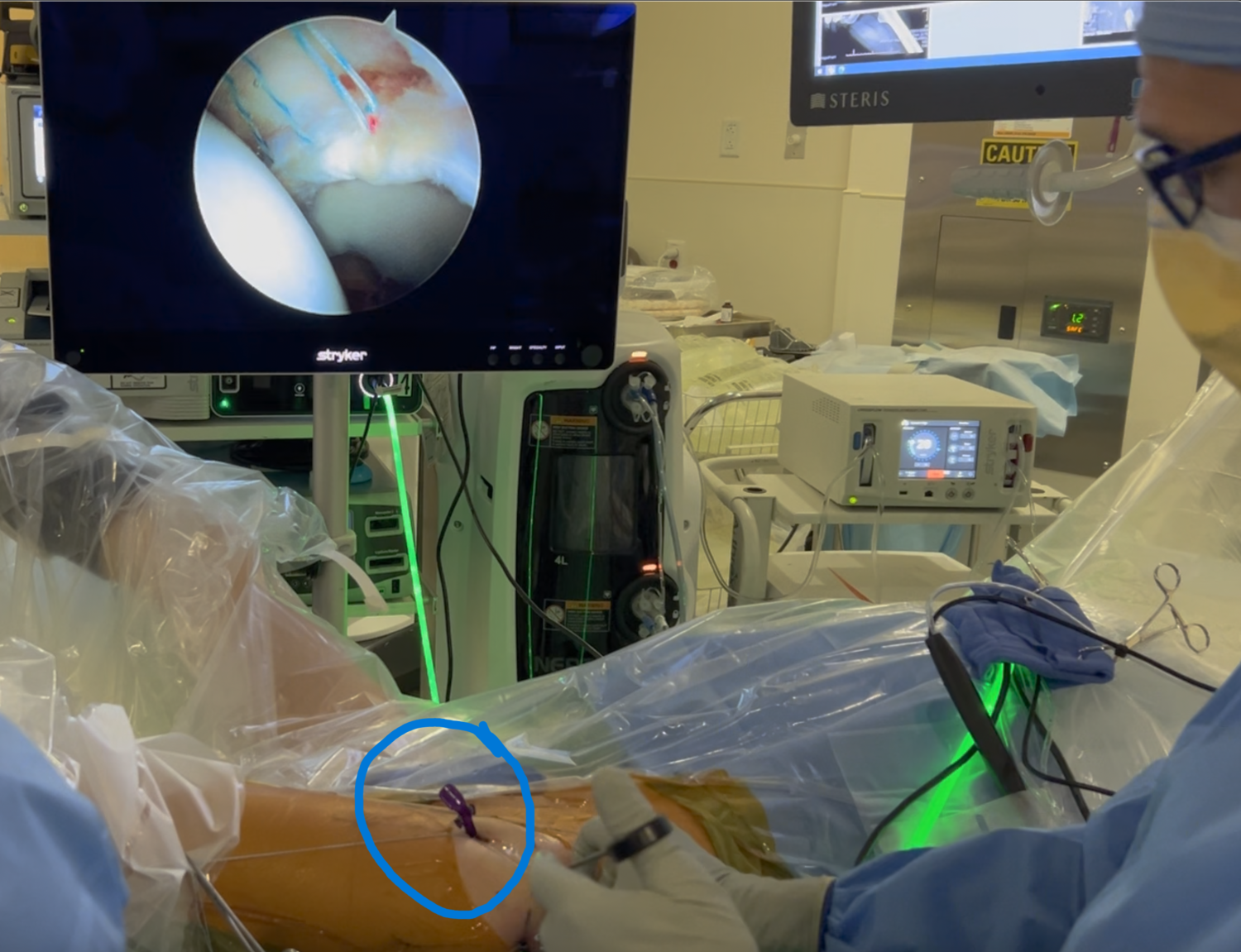 Surgery operating room where the CAP-LIFT cannula is being used