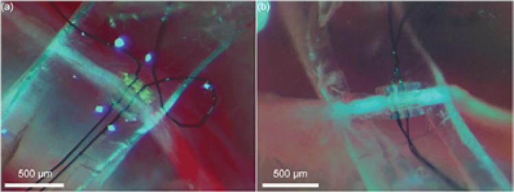 nanoclip on nerve