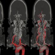 emboli in arterial-brain network