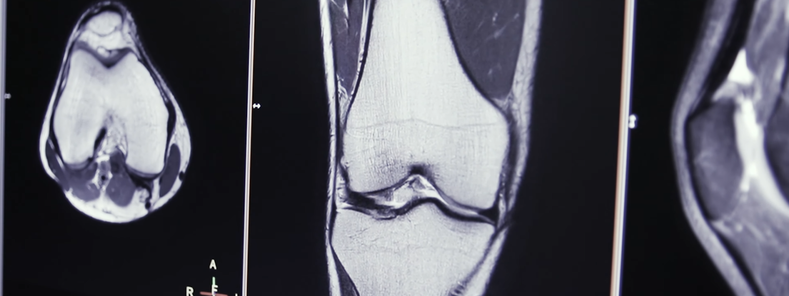 MRI scans of a knee.