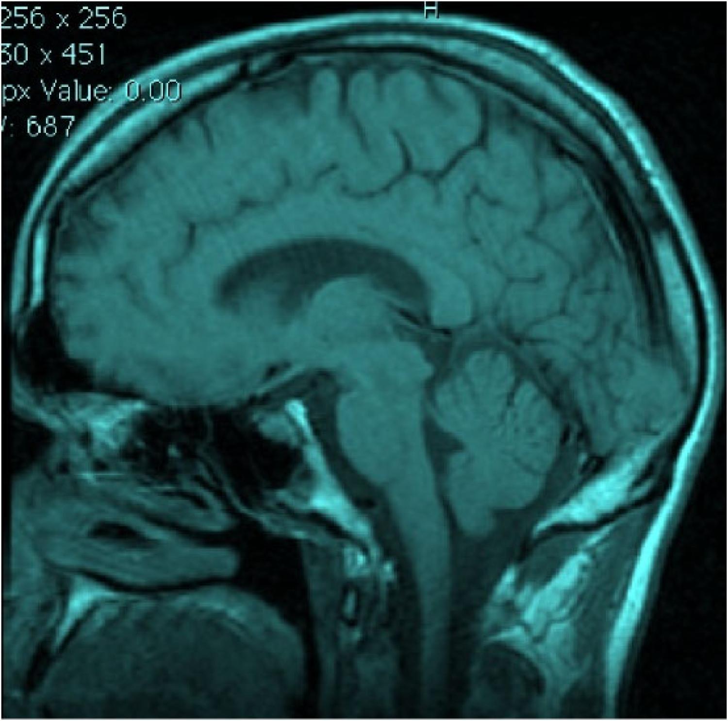 Image of a brain scan