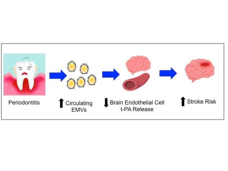Extracellular vesicles mediators of stroke risk with periodontal disease illustration