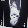 ARPA-H awards up to $39M for non-invasive osteoarthritis therapies