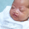 Invisalign for cleft palates? Researchers team up to bring birth-defect treatment home