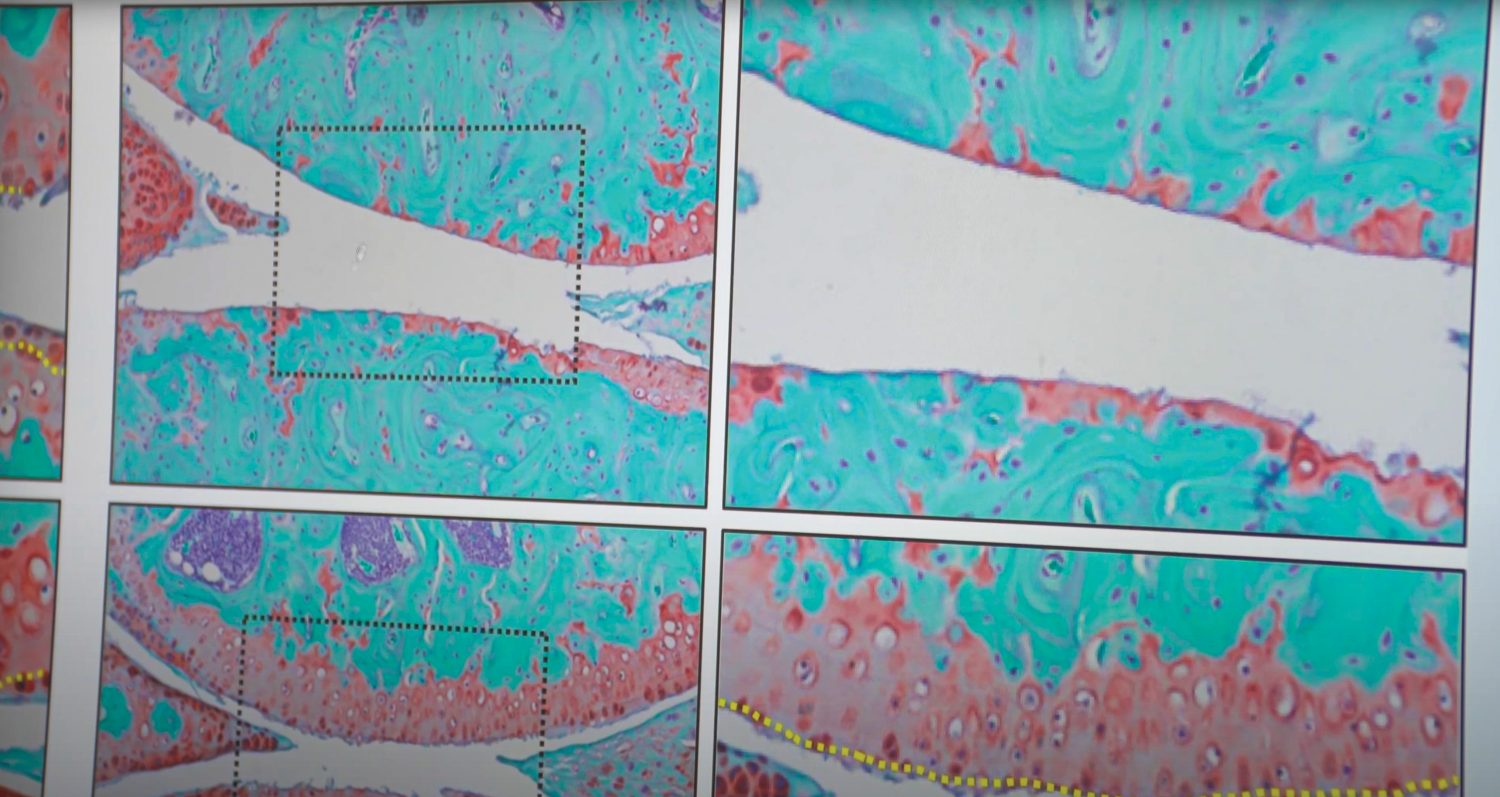 Data visualization of osteoarthritis