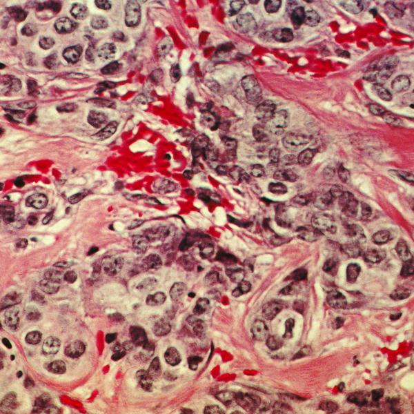 A histological slide of cancerous breast tissue