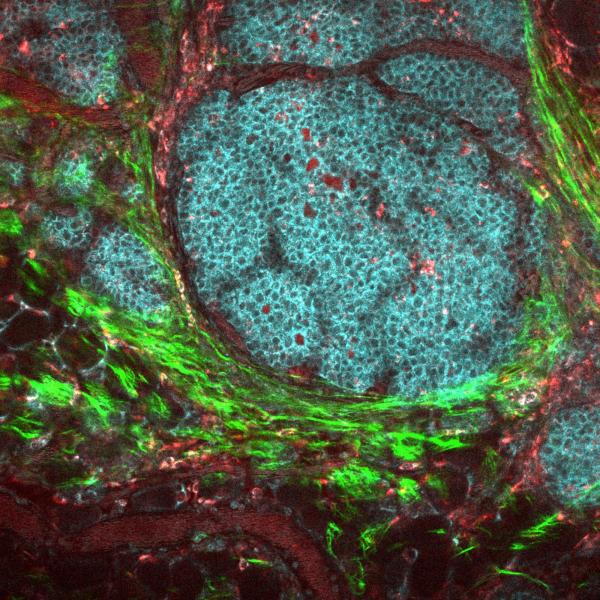 Breast tumor seen under a microscope