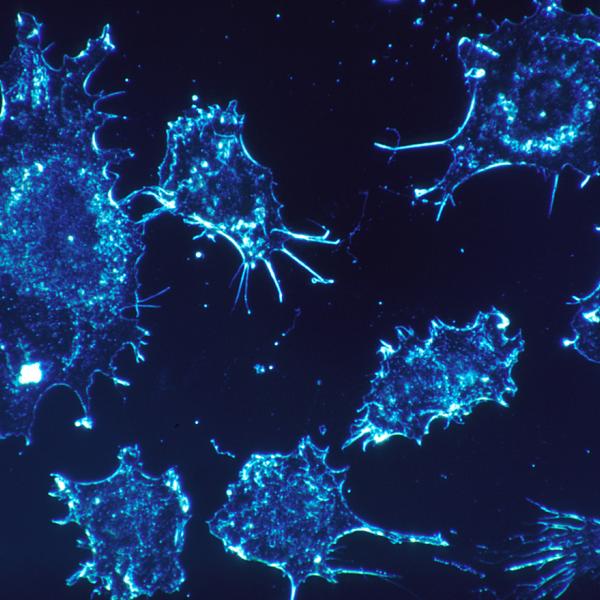 Human cancer cells seen under the microscope