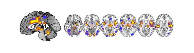 Pain signature in the brain