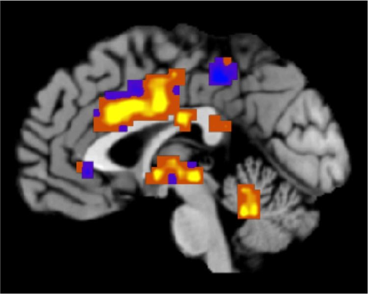 Pain signature in brain