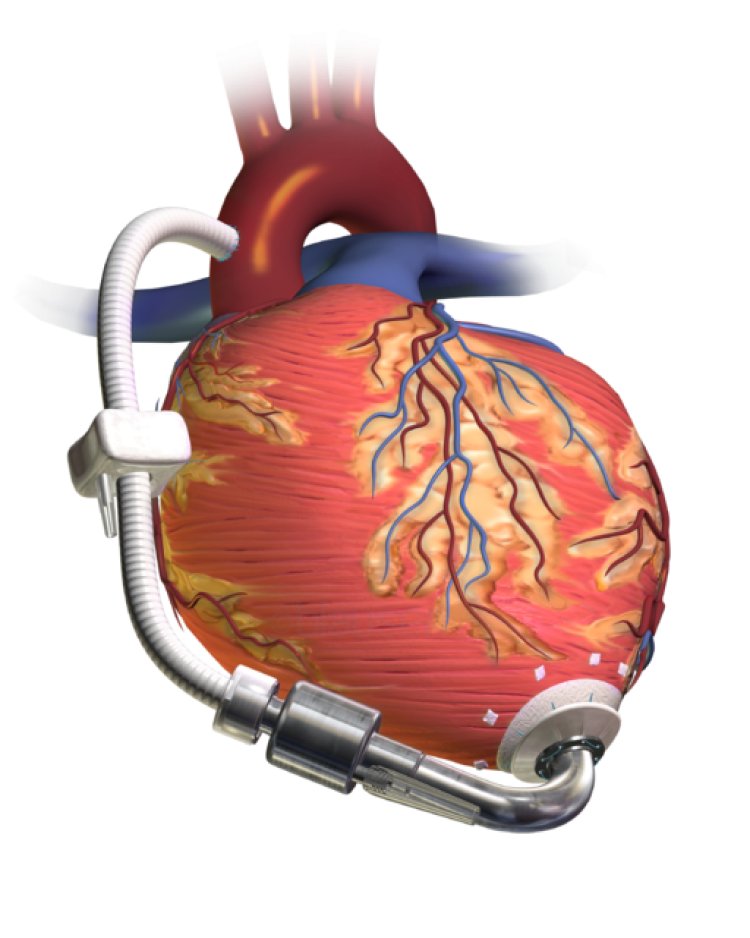 This illustration shows a human heart with a left ventricular assist device attached. The device has a pump and outflow graft that attaches to the aorta.