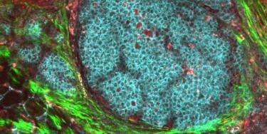 Breast cancer cell picture
