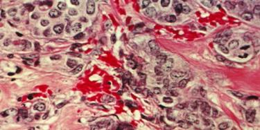 drug-resistant breast and ovarian cancers