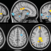 an image of MRI brain scans