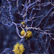 neurons with amyloid plaques