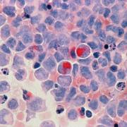 Acute myelocytic leukaemia