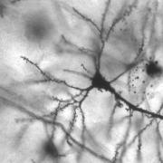 Golgi stained pyramidal neuron in the hippocampus of an epileptic patient.