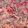 A histological slide of cancerous breast tissue
