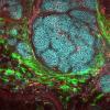 Breast tumor seen under a microscope
