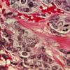 Breast cancer cells seen under the microscope