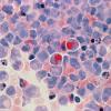 Acute myelocytic leukaemia